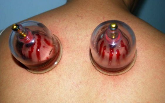 Cupping therapy